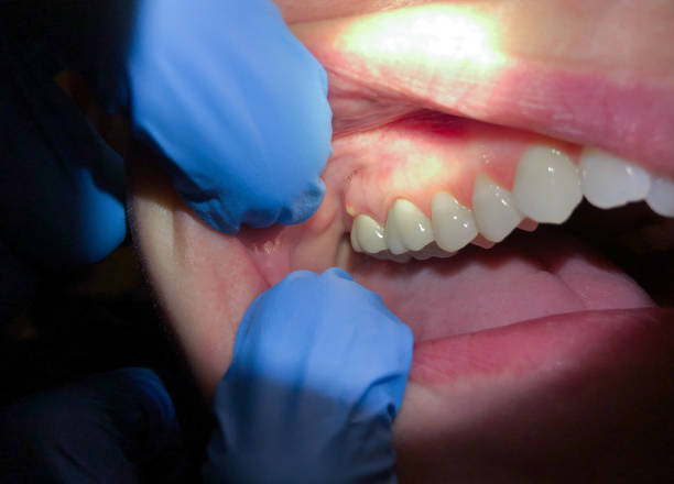 Urgent Tooth Repair in CO