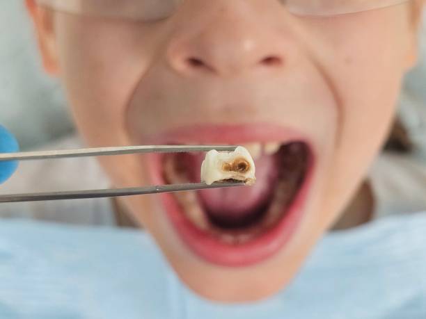 Best Chipped Tooth Repair Near Me  in Derby, CO